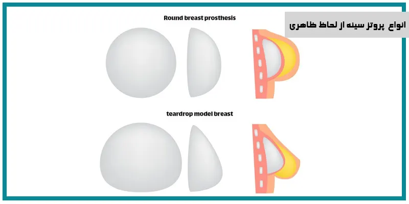 انواع پروتز سینه | دکتر ابوالفضل عباس زاده