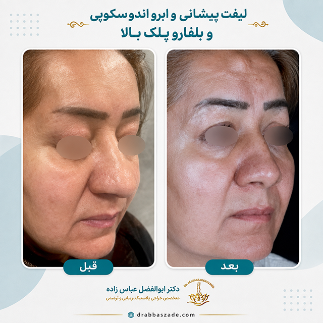 نمونه کار لیفت صورت دکتر عباس زاده
