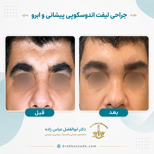 لیفت پیشانی و ابرو