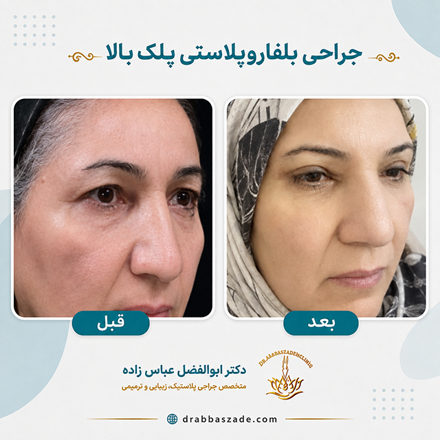 لیفت صورت توسط دکتر عباس زاده