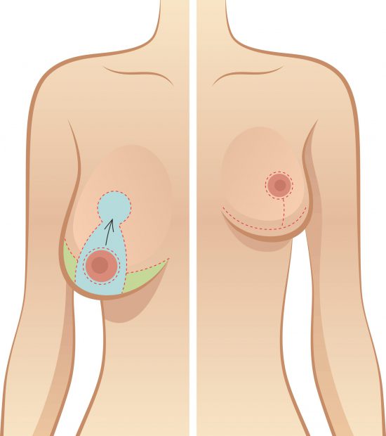 ماموپلاستی سینه