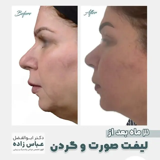 بهترین جراح پلاستیک نمونه کار لیفت صورت و گردن