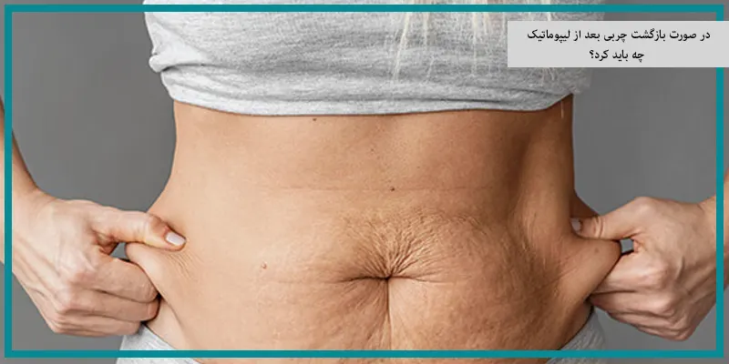 در صورت بازگشت چربی بعد از لیپوماتیک چه باید کرد؟