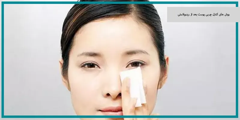 روش های کنترل چربی پوست بعد از رینوپلاستی