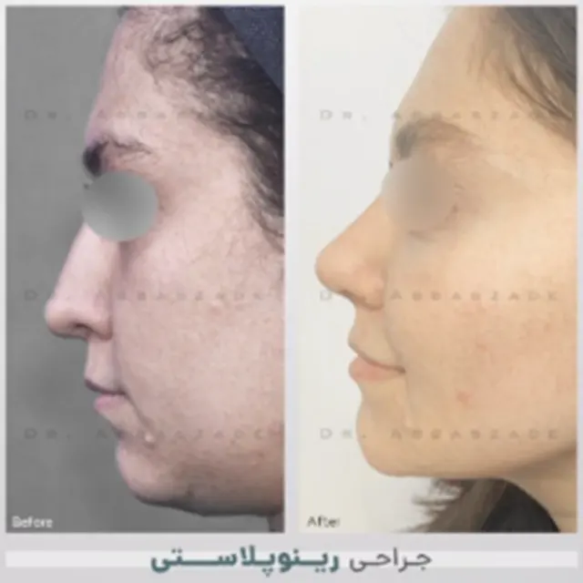 رینوپلاستی جراح پلاستیک نمونه کار