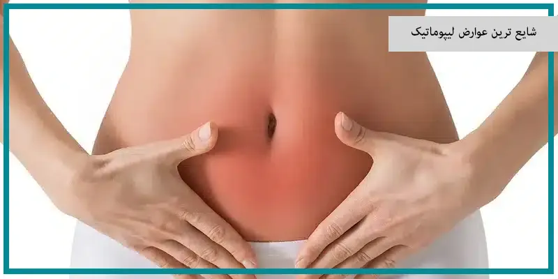 شایع ترین عوارض لیپوماتیک