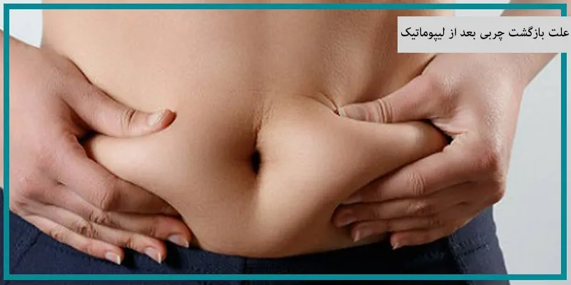 علت بازگشت چربی بعد از لیپوماتیک