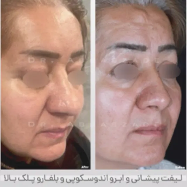 لیفت ابرو و پیشانی جراح پلاستیک نمونه کار