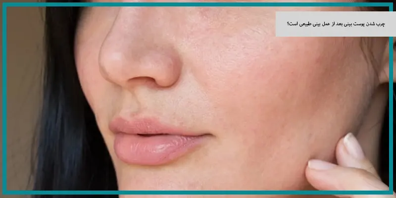 چرب شدن پوست بینی بعد از عمل بینی طبیعی است؟